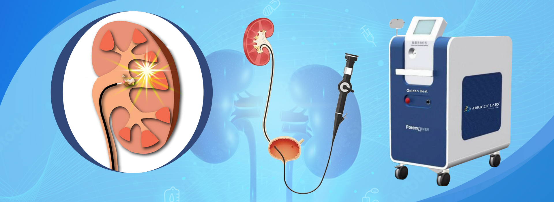 Laser Kidney Stone Surgery Hanamkonda   